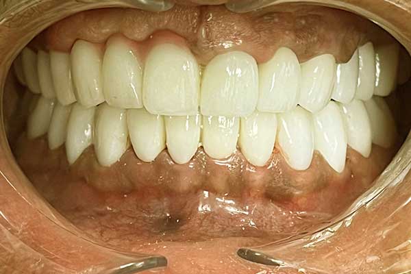 impianto dentale all estero: Guida Completa e Vantaggi di Scegliere una Cura Oltre Confine