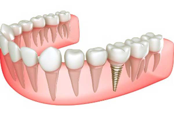 impianto dentale a carico immediato pro e contro