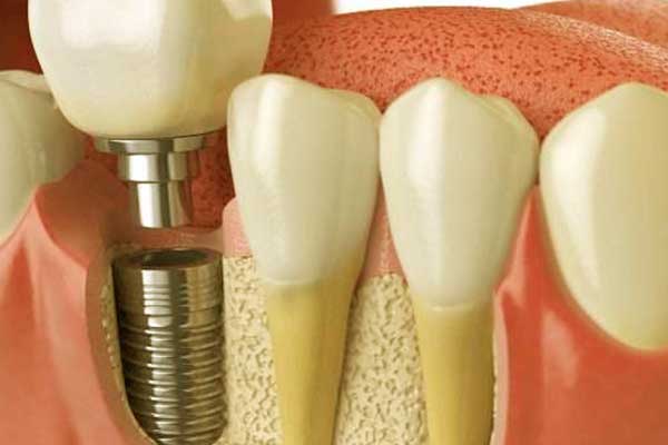 Il Miglior Impianto Dentale: Una Guida Completa Per Scegliere Con Consapevolezza