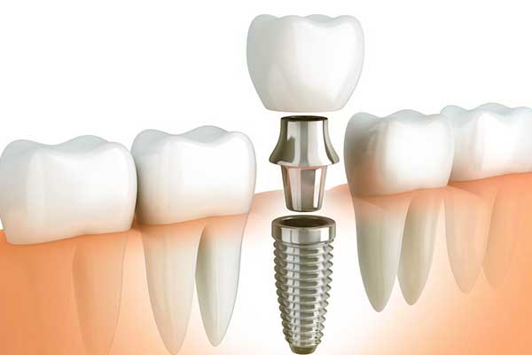 Impianto Dentale Immediato: Una Soluzione Rapida e Efficace per il Tuo Sorriso