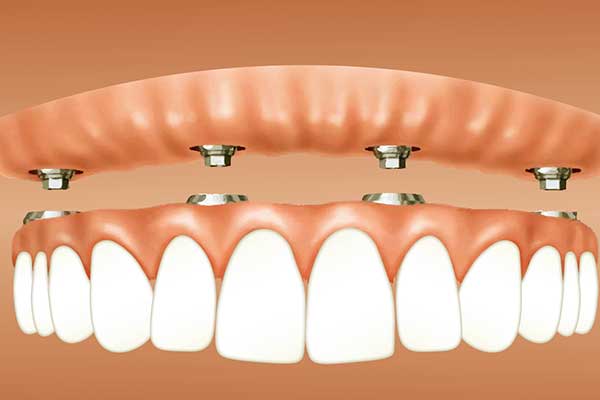 Quanto impianto dentale quanto costa? Guida Completa con Prezzi e Consigli per Risparmiare