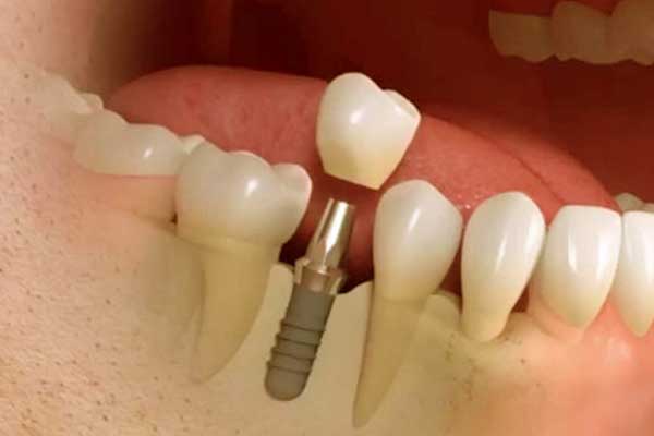 Impianto Dentale in un Giorno: Come Ottenere un Sorriso Perfetto in 24 Ore