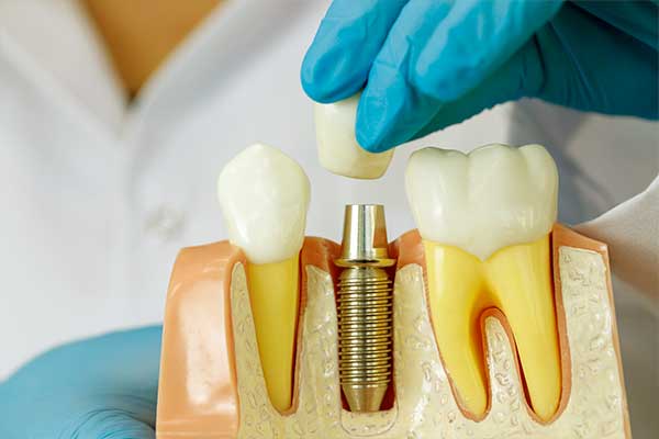 Impianto Dentale Arcata Superiore: Soluzioni Moderne e Benefici Completi