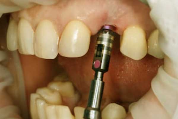 Impianto Dentale Arcata Superiore Prezzi: Cosa Devi Sapere