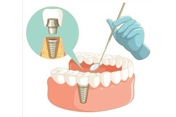 Impianto Dentale Economico: 5 Modi per Risparmiare sui Tuoi Impianti