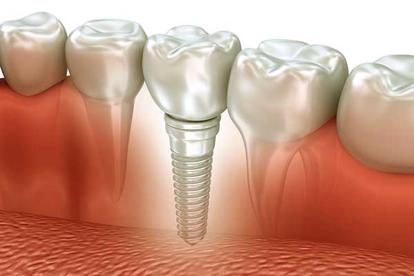 Impianto Dentale Provvisorio: Guida Completa e Vantaggi