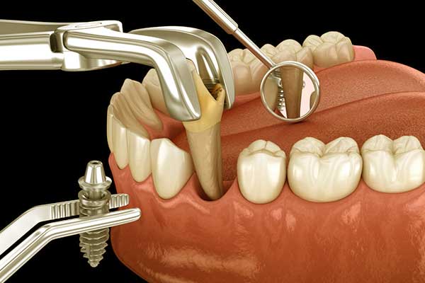 Prezzo Medio Impianto Dentale: Guida Completa 2024