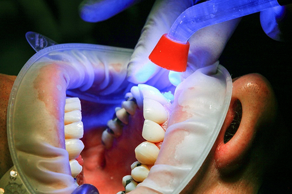 miglioramento denti frontali, come migliorare i denti frontali, migliori tecniche per denti frontali, faccette per denti frontali, Lumineers per denti frontali, costo miglioramento dentale, sbiancamento denti frontali, impianti dentali per denti frontali, apparecchi per denti frontali, metodi naturali per migliorare i denti, rimodellare denti frontali, riparare smalto denti frontali