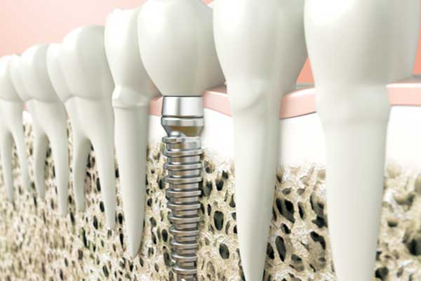 Dental Implants in Serbia vs. Turkey: 7 Reasons Why Turkey Wins!