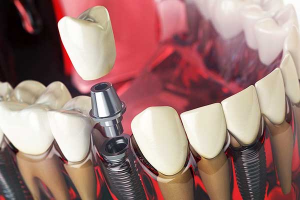 Dental Implants in Bulgaria vs. Turkey: 7 Reasons to Choose Turkey