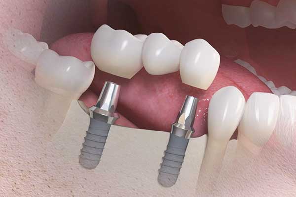 Implantes Dentales en Ucrania Frente a Turquía: ¡5 Razones para Elegir Turquía! 🌟