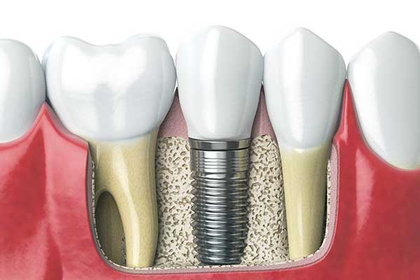 Impianti dentali in Polonia o Turchia