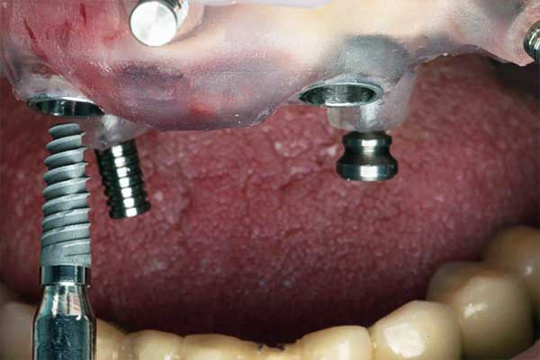 Dental Implants in Romania vs Turkey: 7 Reasons Why Turkey Shines