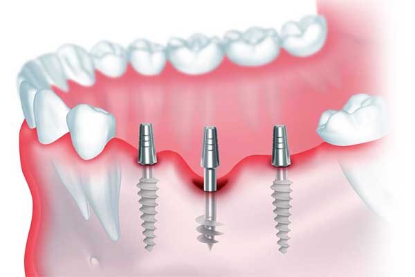 Dental Implants in Poland vs Turkey