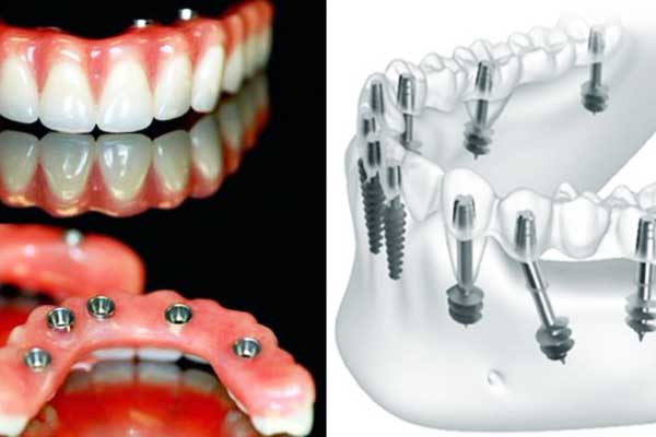 Dental Implants in Croatia vs Turkey: 7 Reasons Why Turkey Is the Clear Winner