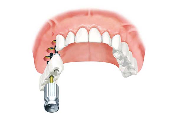 Impianti dentali in India o Turchia: 7 motivi per cui scegliere la Turchia è la scelta migliore 🌍