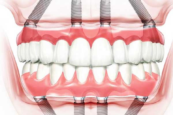 Dental Implants in Hungary vs Turkey: 7 Reasons to Choose Turkey