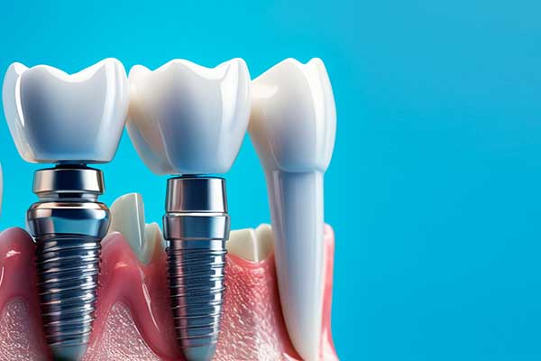 Impianti Dentali nella Repubblica Ceca o in Turchia: 7 Motivi per Scegliere la Turchia! ✨