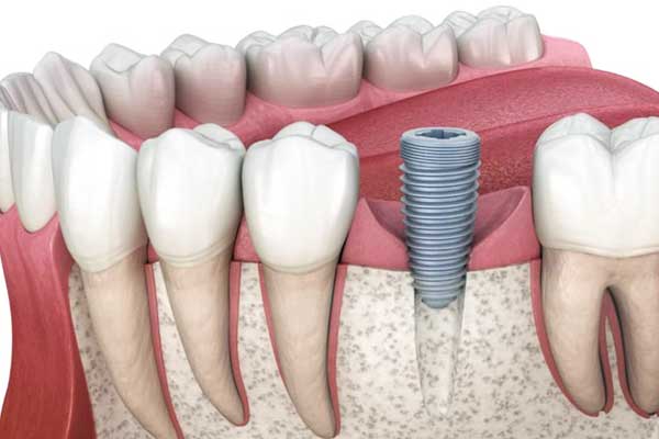 Dental Implants in Ukraine vs Turkey: 7 Reasons Why Turkey Wins 🦷🌟