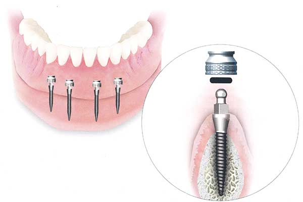 Implantes Dentales en Bulgaria Frente a Turquía: ¡10 Razones para Elegir Turquía! 😍