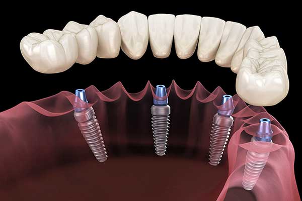 Implantes dentales en Croacia frente a Turquía: ¡Descubre por qué Turquía es tu mejor opción en 2025!