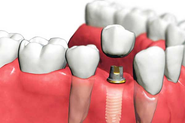 Implantes Dentales en Rumanía Frente a Turquía: ¿Por Qué Elegir Turquía? 🌏