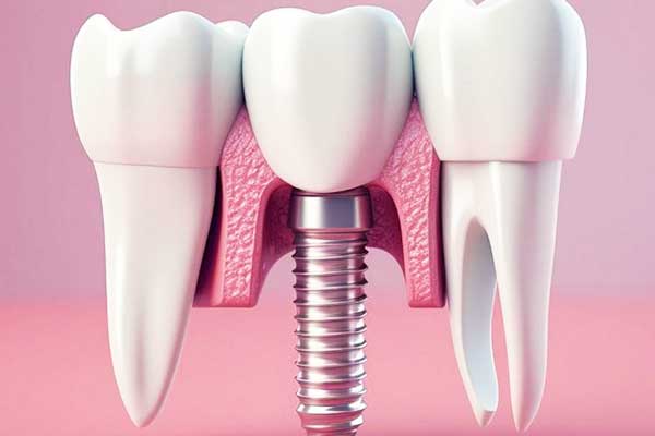 Implantes Dentales en Polonia Frente a Turquía: 7 Razones para Elegir Turquía 🌍✨