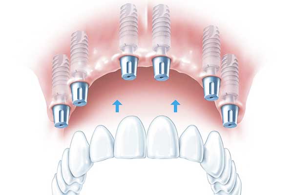 Implantes Dentales en la República Checa Frente a Turquía: ¡Descubre Por Qué Turquía es la Elección Ideal! 🌟