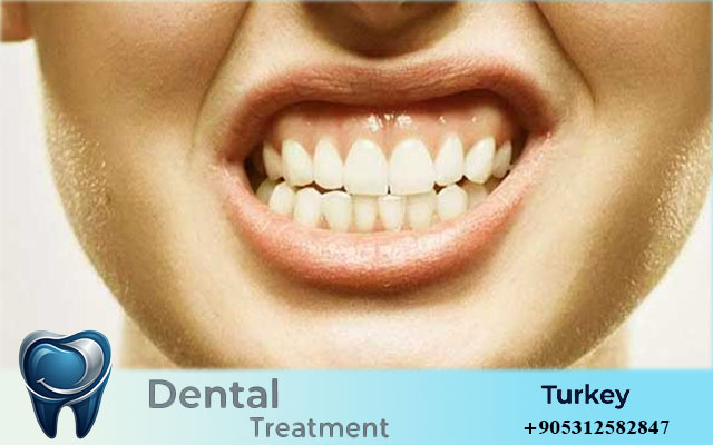 All on 4 Dental Implants Turkey