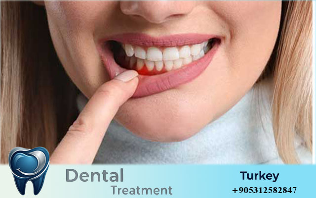 Dental Implants in Istanbul for Foreigners
