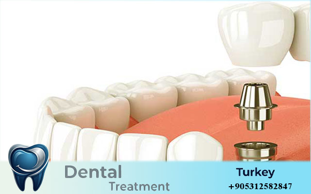 dental implants turkey before and after