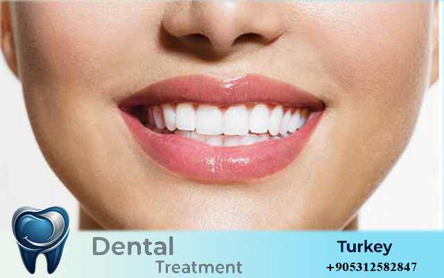 veneers in turkey