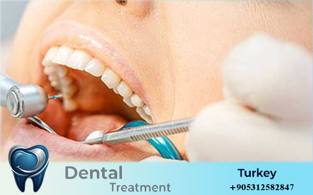 porcelain veneers turkey cost