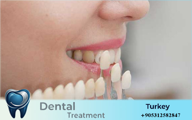 composite veneers turkey