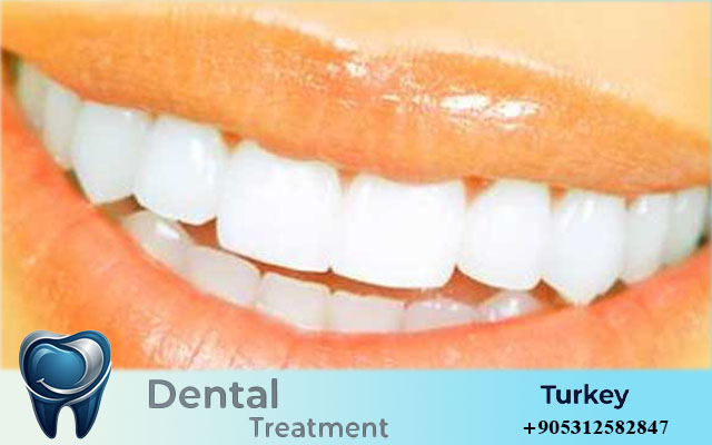 hollywood smile turkey price