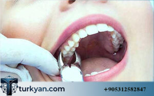 veneers turkey