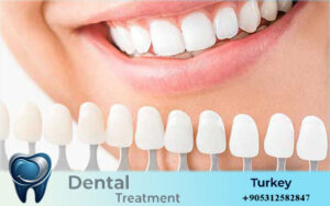 dental implants cost turkey